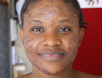 follow-these-5-natural-steps-and-say-bye-bye-to-pimples