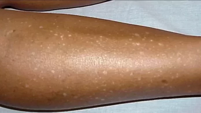 white-spots-on-legs-what-causes